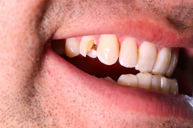 Не только из-за сладостей. Можно ли заразиться кариесом от другого