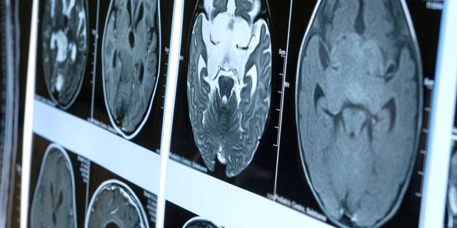 Учёные обнаружили следы коронавируса в мозге умерших пациентов | Все о коронавирусе | Здоровье