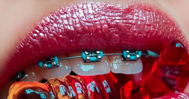 Брекеты: 5 мифов, в которые многие продолжают верить — Будь здорова!