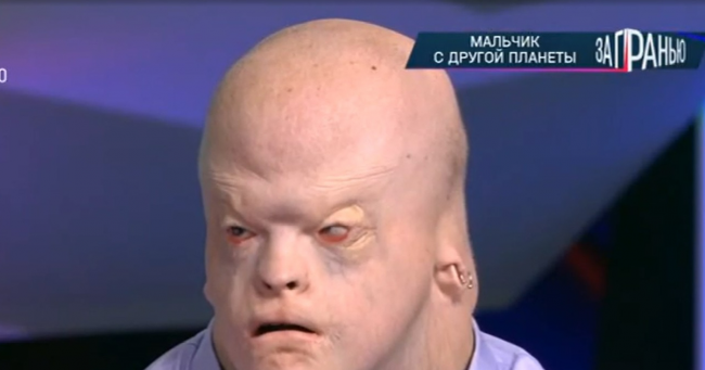 В мире всего 16 таких людей: 18-летний Алексей с внешностью гуманоида живет в приемной семье
