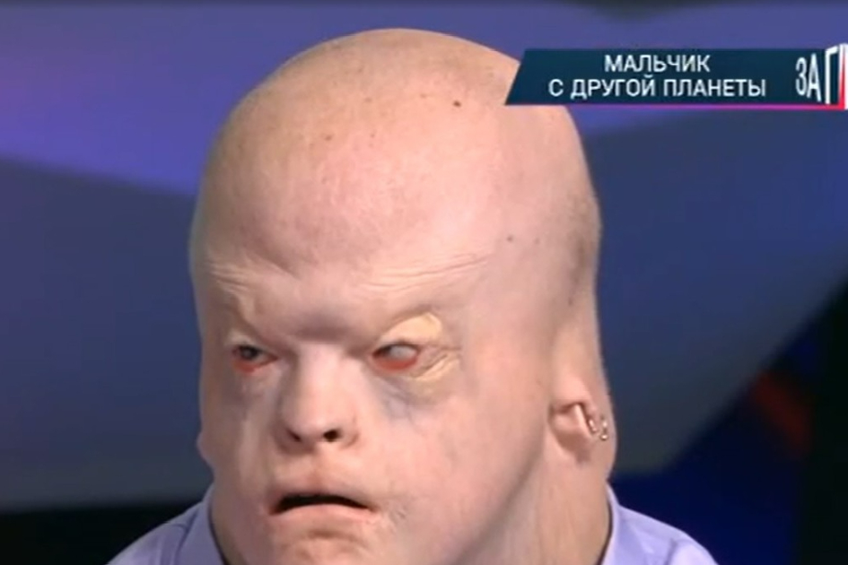 В мире всего 16 таких людей: 18-летний Алексей с внешностью гуманоида живет в приемной семье