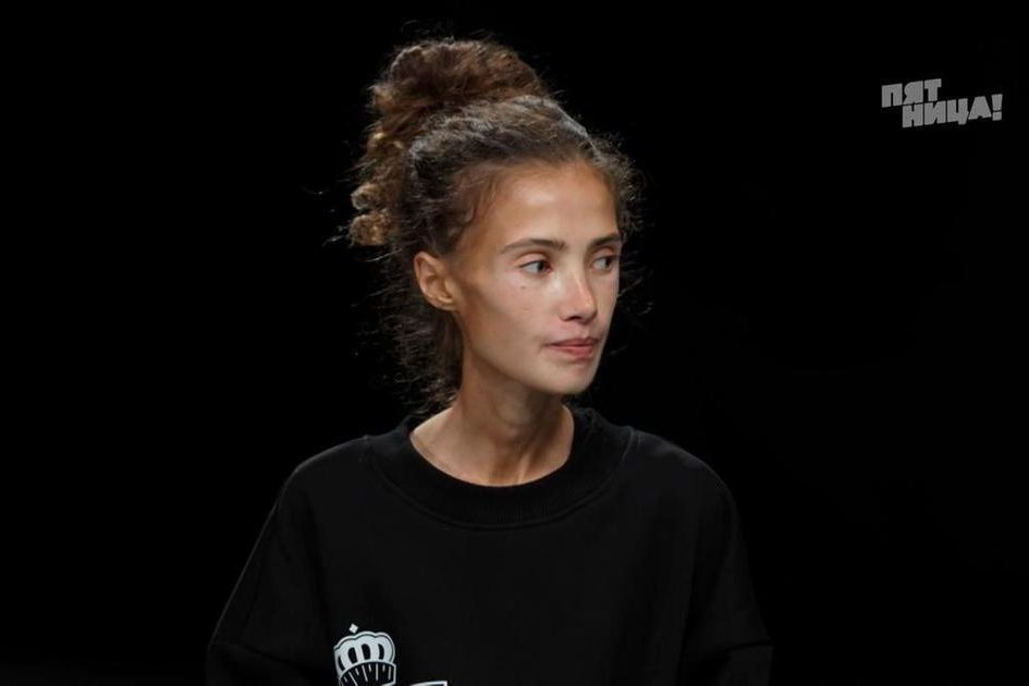 Весят 33 кг, слоятся ногти, не могут ходить: шокирующая встреча «Больших