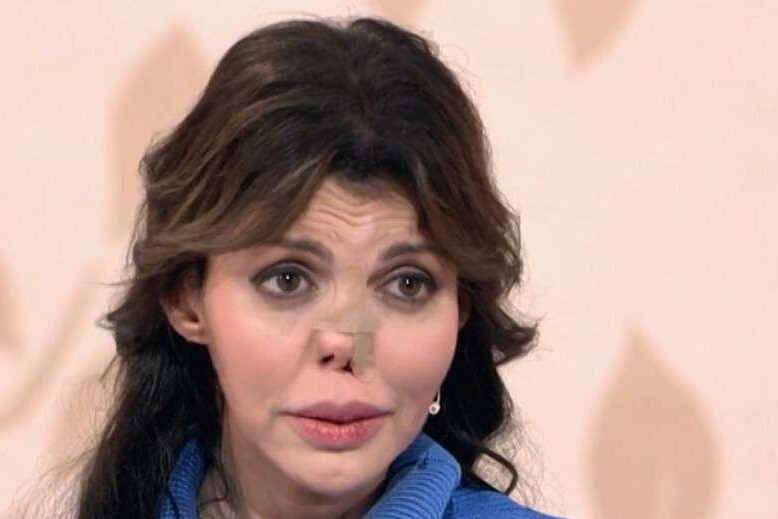 Экс-супруга Аршавина Алиса Казьмина сделала очередную пластику носа