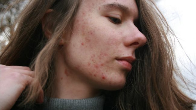 Почему у взрослых появляется акне на лице и теле — и как с этим справляться