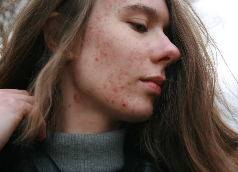 Почему у взрослых появляется акне на лице и теле — и как с этим справляться